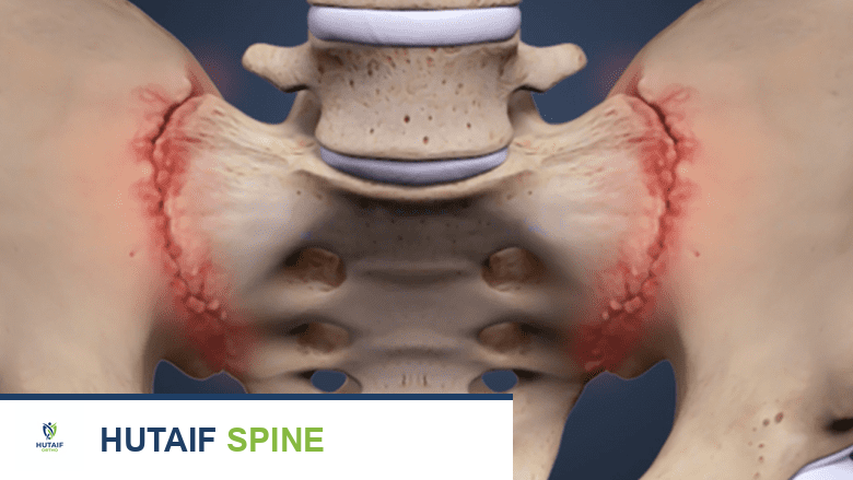 تصوير يوضح المفصل العجزي الحرقفي (SI joint) مظللاً باللون الأحمر، مما يشير إلى منطقة الألم المحتملة.