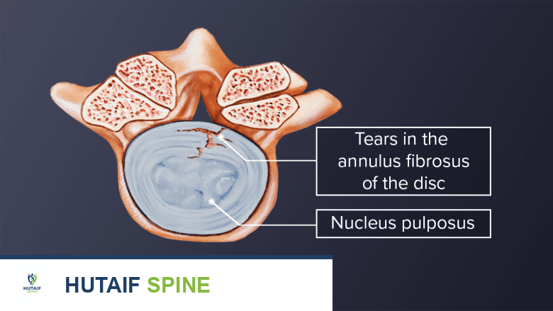 عرض للتمزقات في الحلقة الليفية للقرص والنواة اللبية.