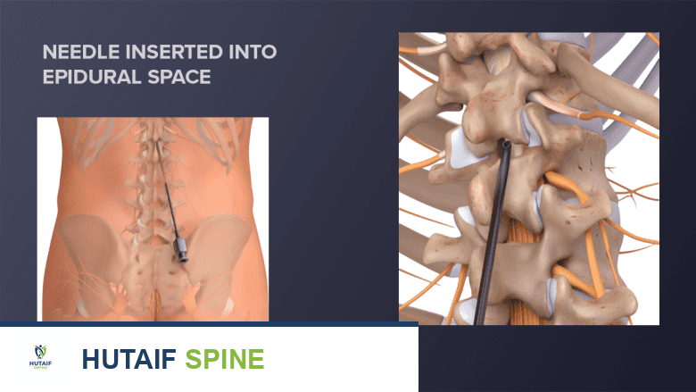 A needle inserted into the epidural space.