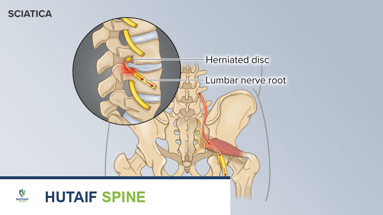 A herniated disc pressing the lumbar nerve root and causing sciatica pain.