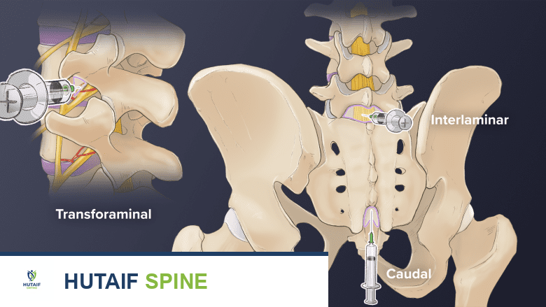 Injection site of transforaminal, interlamniar, and caudal injections in the spinal cord