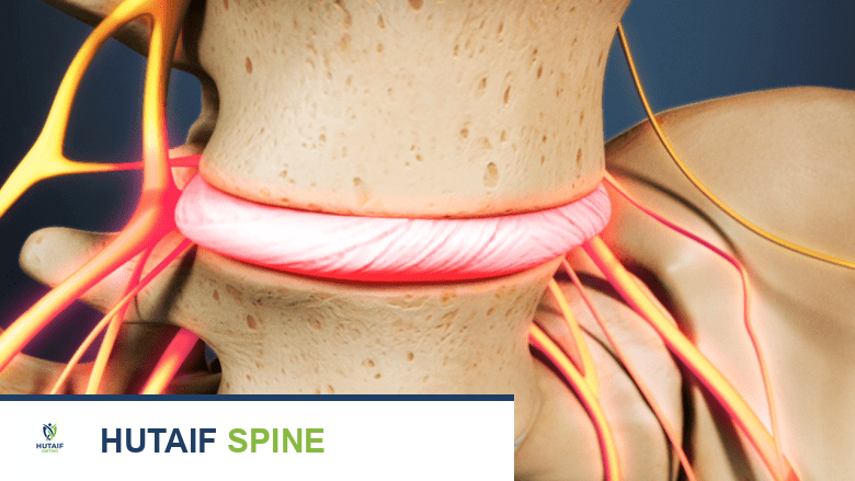 حقن الستيرويد فوق الجافية القطنية: حل فعال لآلام الظهر وعرق النسا