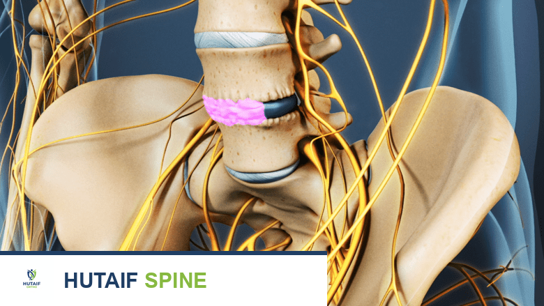 جراحة دمج وتثبيت الفقرات القطنية: دليل شامل للمرضى مع الأستاذ الدكتور محمد هطيف