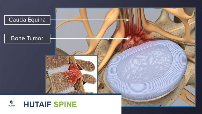 ورم عظمي يضغط على أعصاب ذنب الفرس في أسفل العمود الفقري