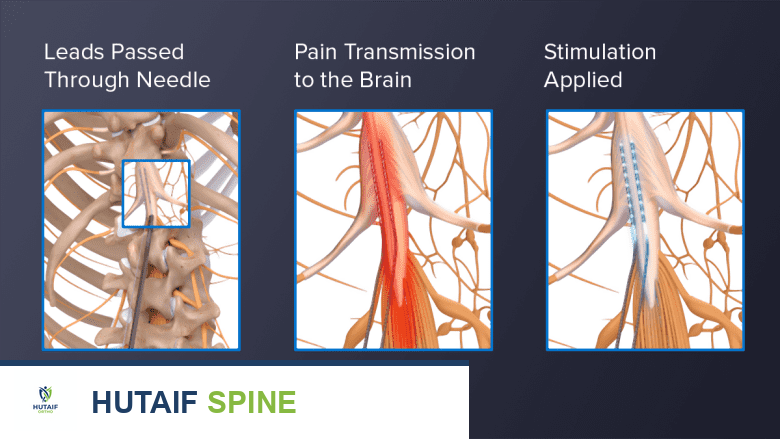 تحفيز كهربائي للحبل الشوكي للمساعدة في تخفيف الألم