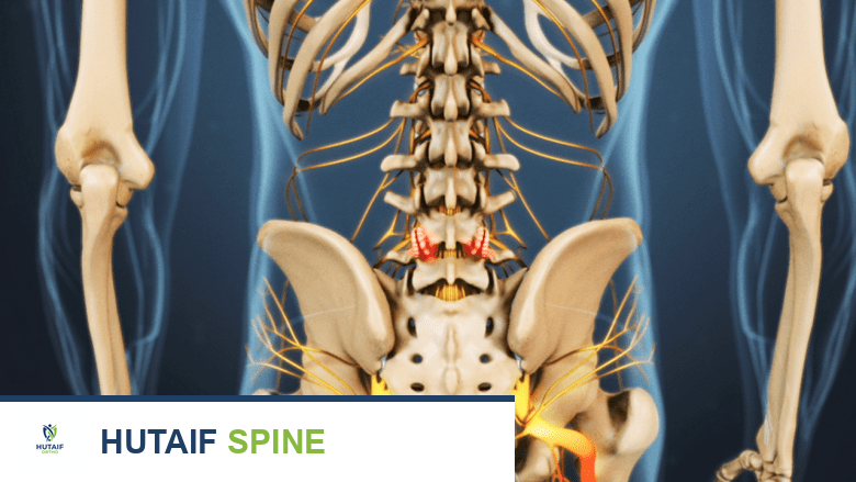 نتوءات عظمية تضغط على جذور الأعصاب في أسفل الظهر