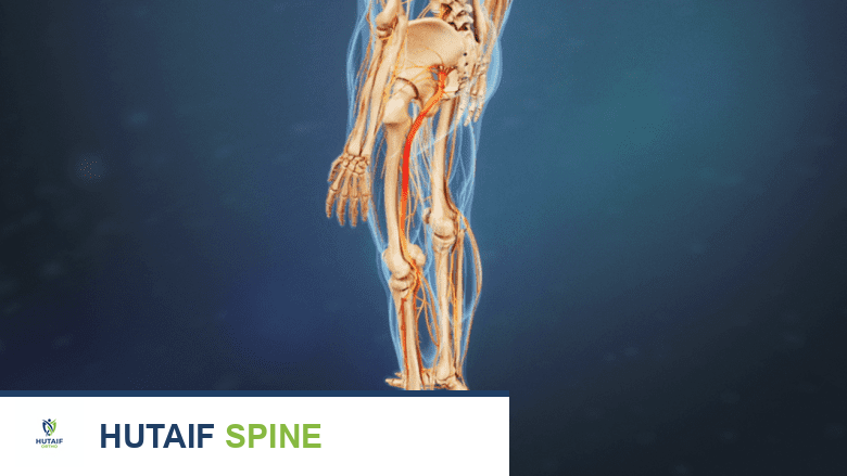 ألم عصبي يمتد من الحوض إلى الساق والقدم