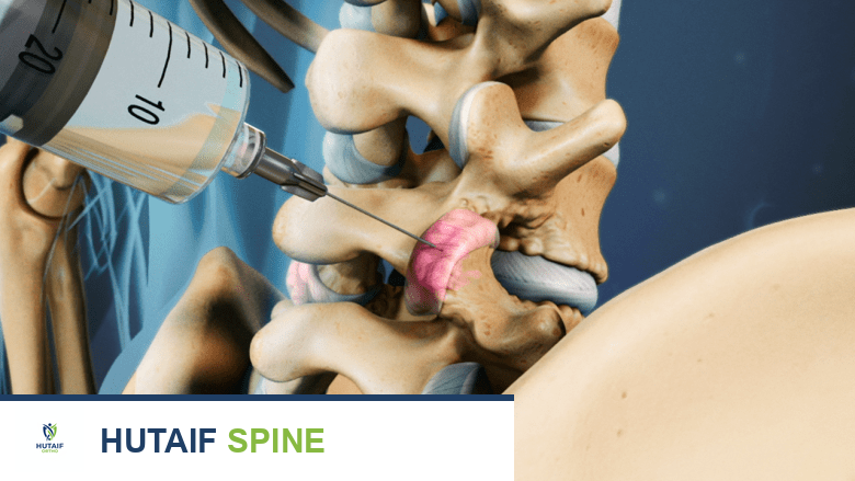 صورة توضيحية لـ علاج تضيق القناة الشوكية القطنية: دليل شامل من الأستاذ الدكتور محمد هطيف في صنعاء