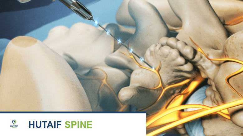صورة توضيحية لـ علاج تضيق القناة الشوكية القطنية: دليل شامل من الأستاذ الدكتور محمد هطيف في صنعاء