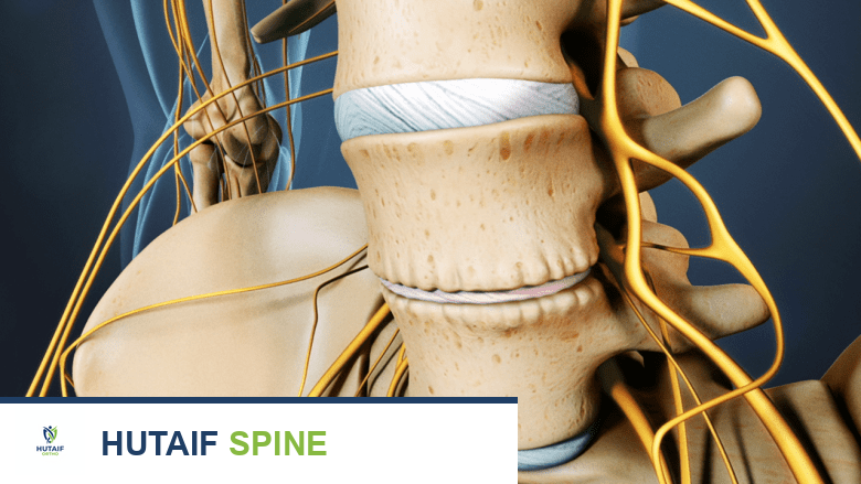 ترقق القرص الفقري بسبب الجفاف مما يضغط على الأعصاب الشوكية.