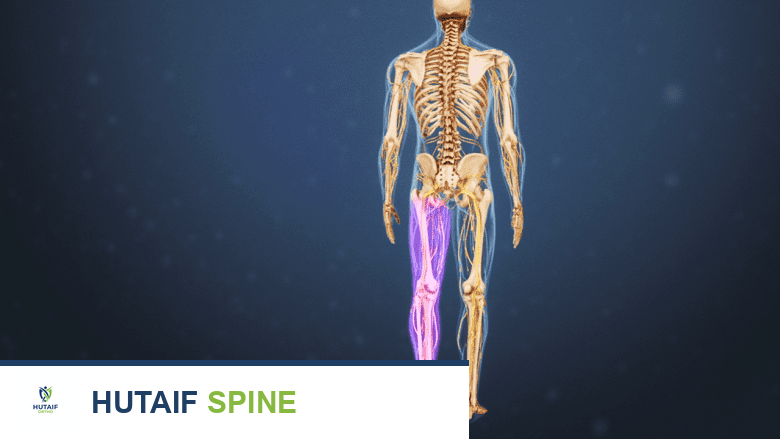 ألم ينتشر أسفل الظهر والأرداف والساق في جانب واحد.
