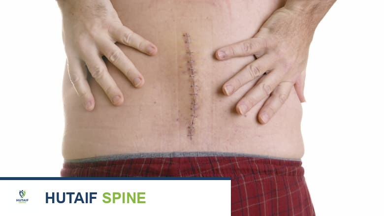 غرزة بطول 4-6 بوصات على أسفل ظهر شخص.