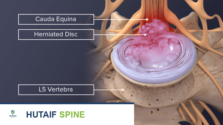 قرص غضروفي شديد الانفتاق يضغط على أعصاب ذيل الفرس في أسفل العمود الفقري.