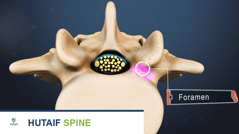 عرض مقطعي عرضي لفقرة مع إبراز الثقبة.
