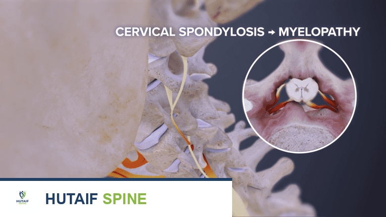 صورة توضيحية لـ العلاج اليدوي وتحريك المفاصل للرقبة المتيبسة المزمنة: حلول فعالة تحت إشراف الأستاذ الدكتور محمد هطيف