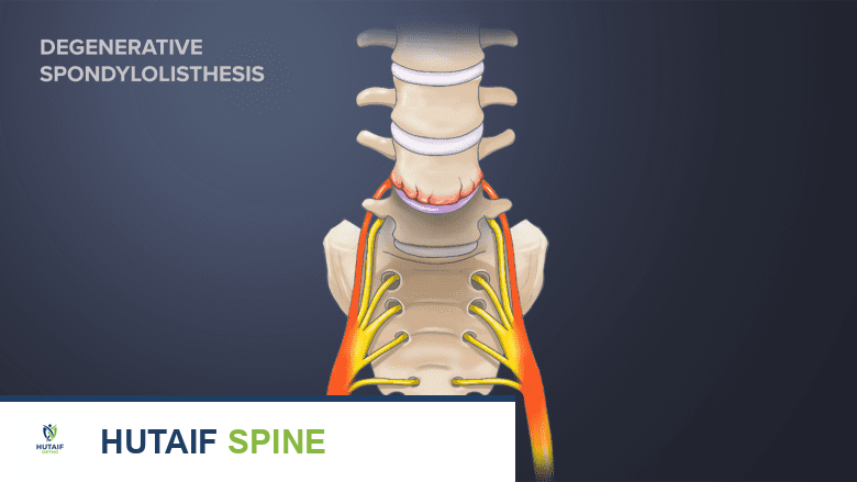 حقن الأعصاب الفرعية الوسطى: دليل شامل لتشخيص وعلاج آلام الظهر والمفاصل الوجيهية مع الأستاذ الدكتور محمد هطيف