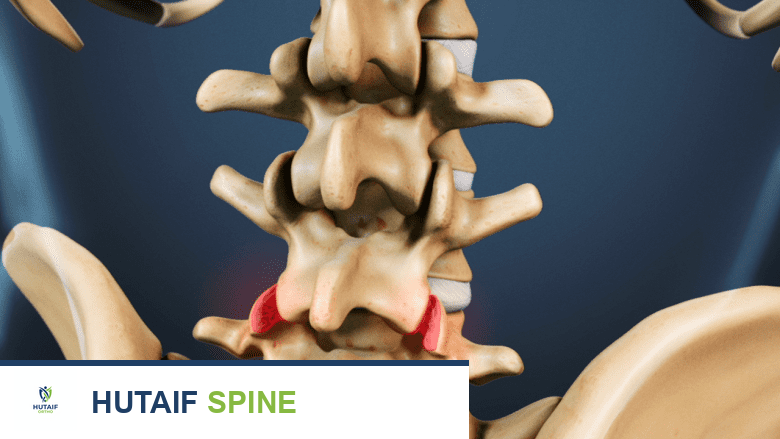 توضح الصورة مفصل الوجه في العمود الفقري القطني، حيث يرتبط تنكس مفصل الوجه بزيادة خطر المضاعفات بعد الجراحة.