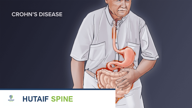 رسم توضيحي يظهر شخصًا يعاني من مشكلة في الجهاز الهضمي.
