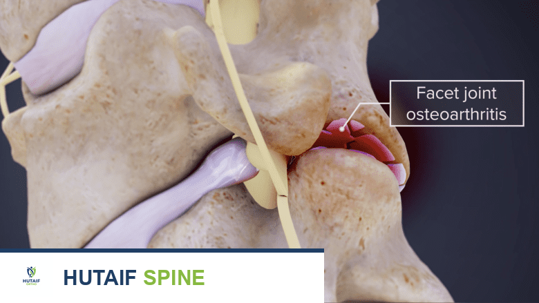توضيح يظهر التهاب المفاصل الوجيهي.