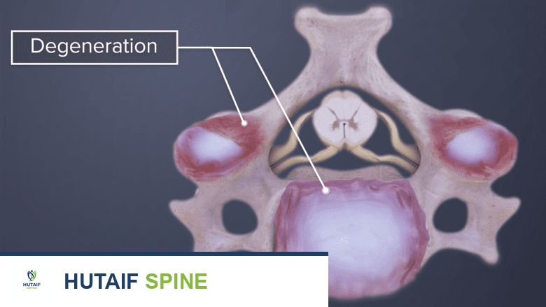 Illustration showing degeneration in the cervical disc.