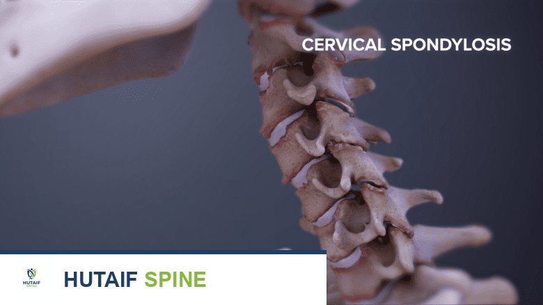 آلام الرقبة والتهاب الفقار اللاصق: دليل شامل للعلاج والتعافي مع الأستاذ الدكتور محمد هطيف