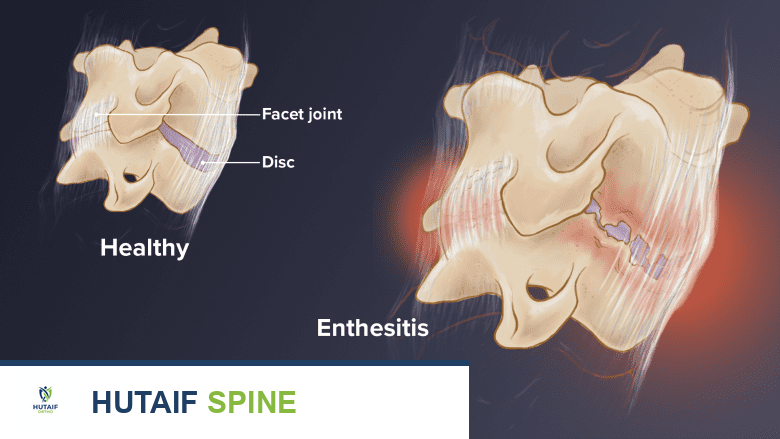 صورة توضيحية لـ آلام الرقبة والتهاب الفقار اللاصق: دليل شامل للعلاج والتعافي مع الأستاذ الدكتور محمد هطيف