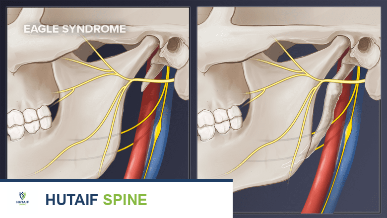 توضيح يقارن بين النتوء الإبري الطبيعي والمتطاول.
