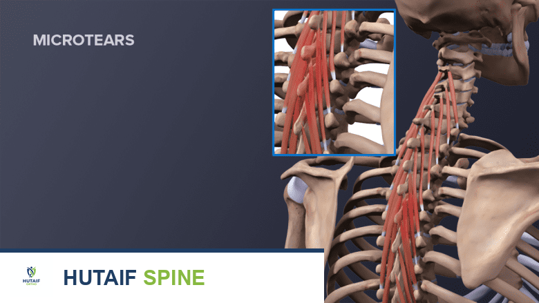 توضيح يظهر عمود فقري لشخص بالغ مع تمزق عضلي في منطقة أعلى الظهر.