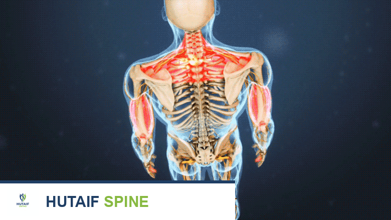 توضيح يظهر الكتف والذراعين باللون الأحمر، مما يشير إلى ألم الرقبة المنتشر إلى الكتف والذراع والذي قد يتطلب عناية طبية فورية.