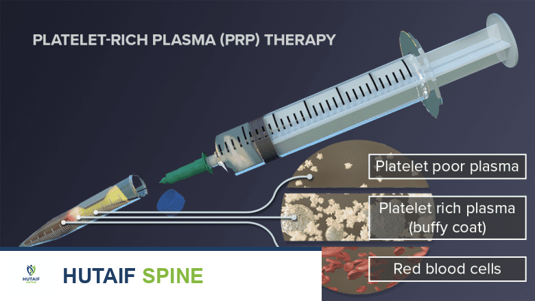 توضيح يظهر مكونات الحقنة المستخدمة في العلاج التكاثري.