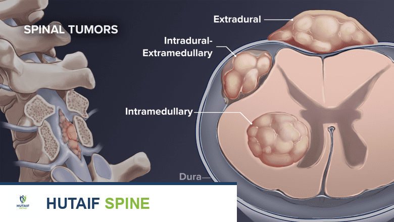 Illustration showing tumor in the spine and a cross-section of the spinal cord.