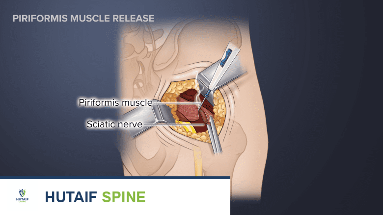 جراحة متلازمة الكمثري في صنعاء: دليل شامل مع الأستاذ الدكتور محمد هطيف