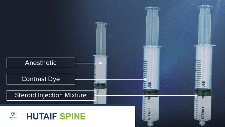 رسم توضيحي يوضح مكونات حقن الستيرويد فوق الجافية.