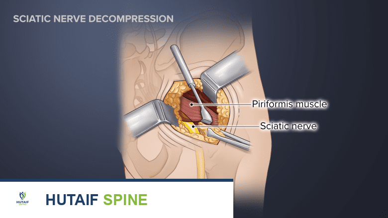 رسم توضيحي يوضح جراحة تخفيف ضغط العصب الوركي.