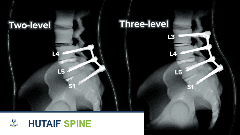 عملية دمج الفقرات القطنية الخلفي (PLIF): دليلك الشامل للمميزات، المخاطر، والتعافي