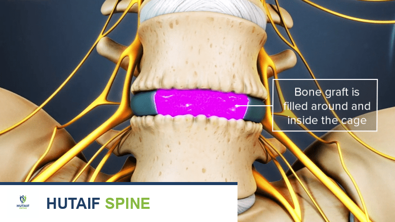 رسم توضيحي يوضح الطعم العظمي في جراحة الاندماج.