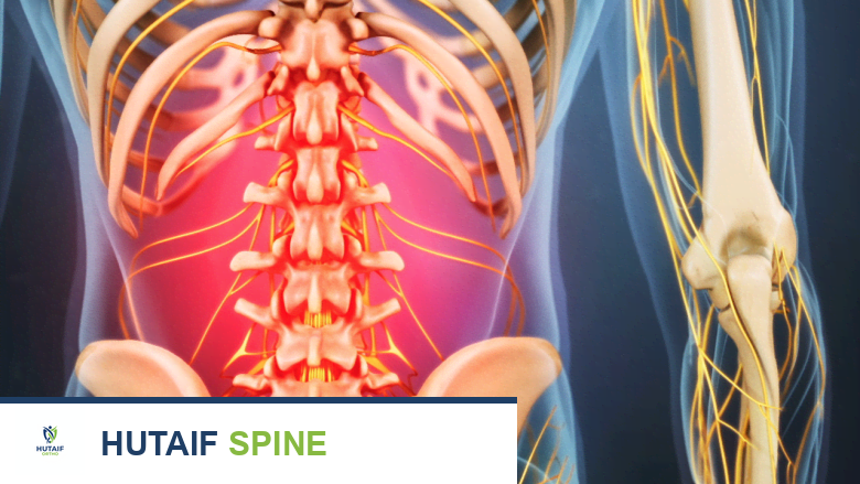 التعافي بعد جراحة استئصال الغضروف المجهري القطني: دليل شامل من الأستاذ الدكتور محمد هطيف