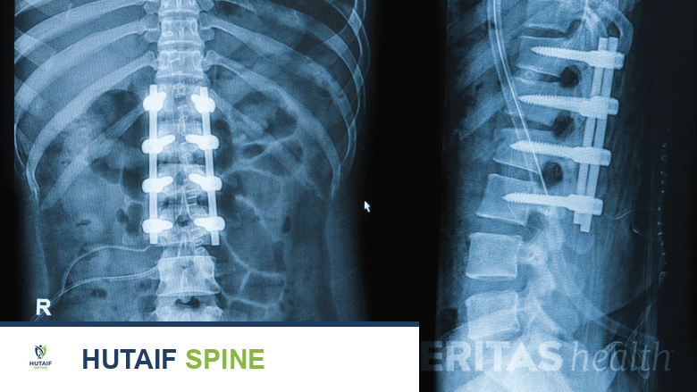 Spinal x-ray showing pedicle screws and rods across 3 spinal segments.