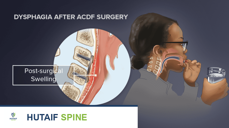 عسر البلع: الأسباب المحتملة، الأعراض، والحلول العلاجية مع الأستاذ الدكتور محمد هطيف