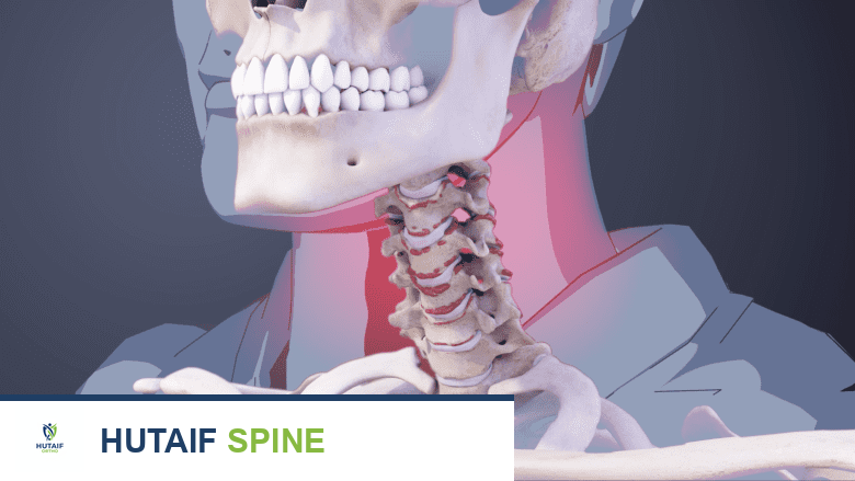 Illustration showing cervical vertebrae with bone spurs andred highlight on the neck.