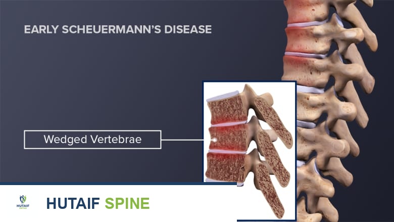 Profile view of a wedged vertebrae in early Scheuermann's disease.