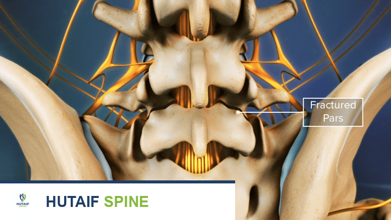 Illustration showing fractured pars interarticularis in the lumbar spine.