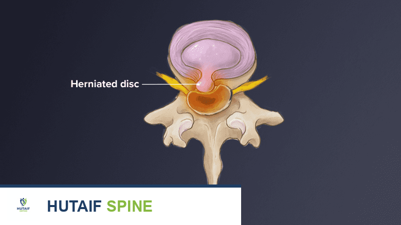 Cross section view of spinal cord under pressure from bulging disc.