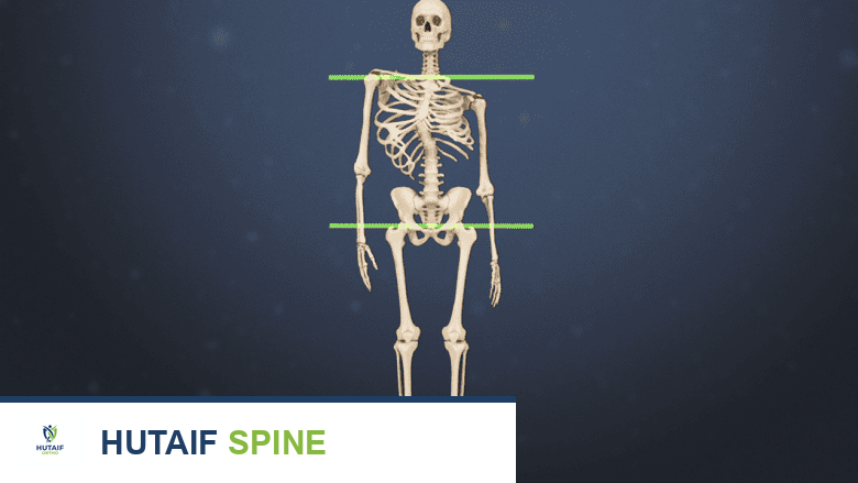 Illustration showing a skeleton with scoliosis.