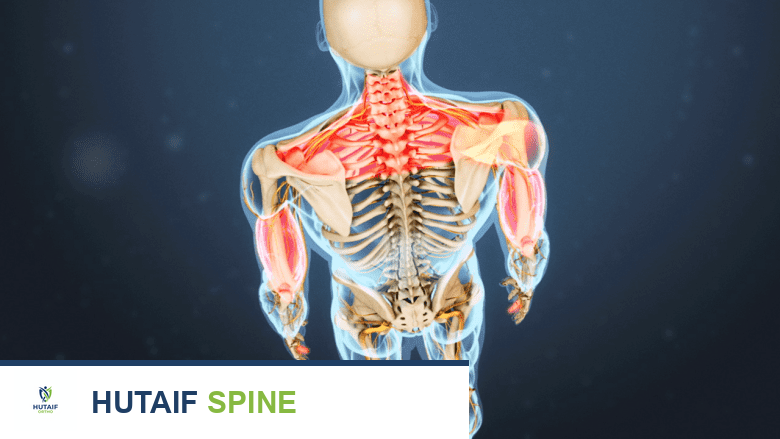 مضاعفات ومخاطر جراحة استبدال القرص العنقي: دليل شامل من الأستاذ الدكتور محمد هطيف