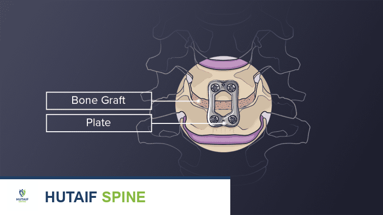 Illustration showing metal plate placed in the cervical vertebra.