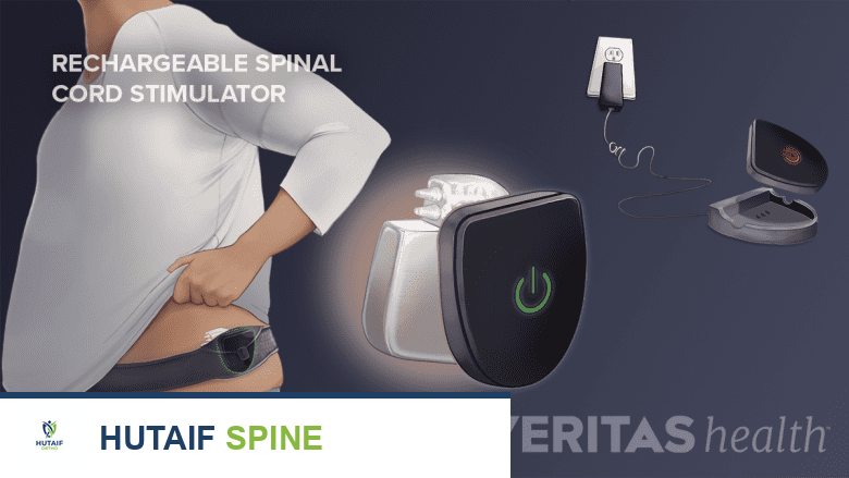 إعادة شحن محفز الحبل الشوكي القابل لإعادة الشحن: دليلك الشامل من الأستاذ الدكتور محمد هطيف