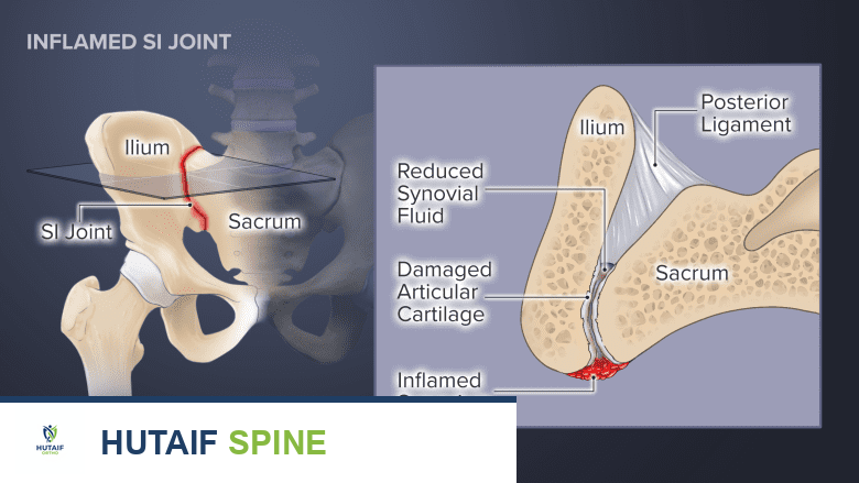 خلل المفصل العجزي الحرقفي: الأعراض، الأسباب، والحلول العلاجية المتقدمة مع الأستاذ الدكتور محمد هطيف في صنعاء