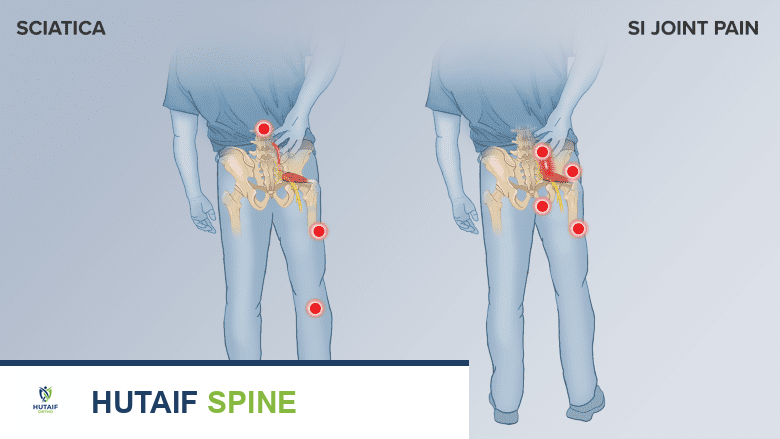 تمارين فعالة للمفصل العجزي الحرقفي لتخفيف ألم عرق النسا: دليل شامل
