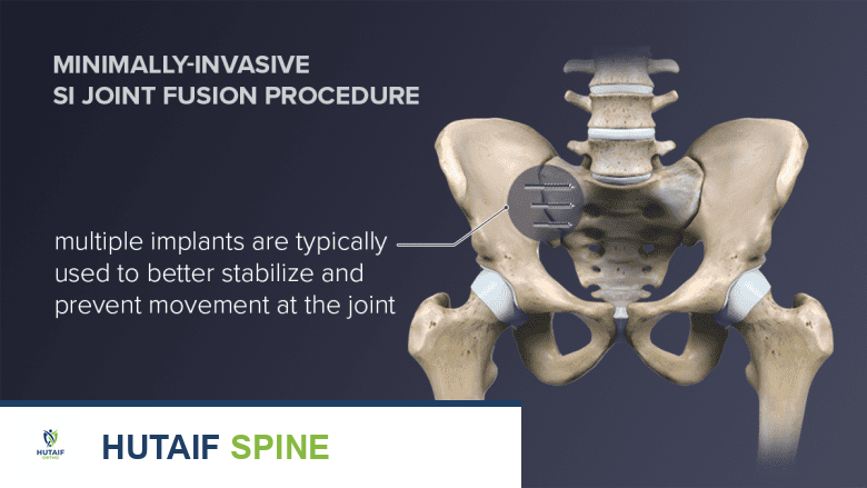 صورة للورك والحوض، مع غرسة معدنية تربط المفصل العجزي الحرقفي.